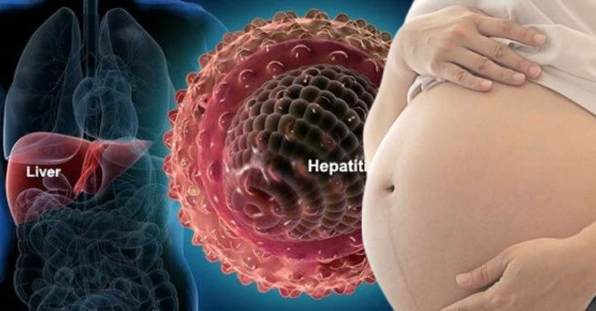 गर्मीमा हेपाटाइटिसको जोखिम बढ्दो, गर्भावस्थामा सङ्क्रमण भए २५ प्रतिशतसम्मको मृत्यु